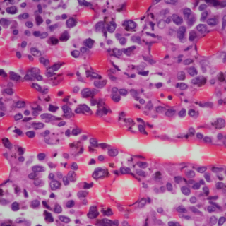 lung tissue adenocarcinoma as seen under a microscope.